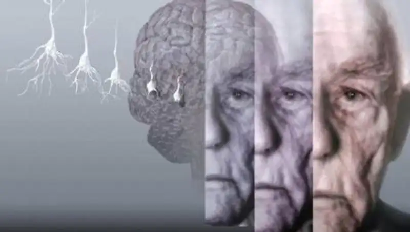 Названы первые признаки смертельной болезни мозга