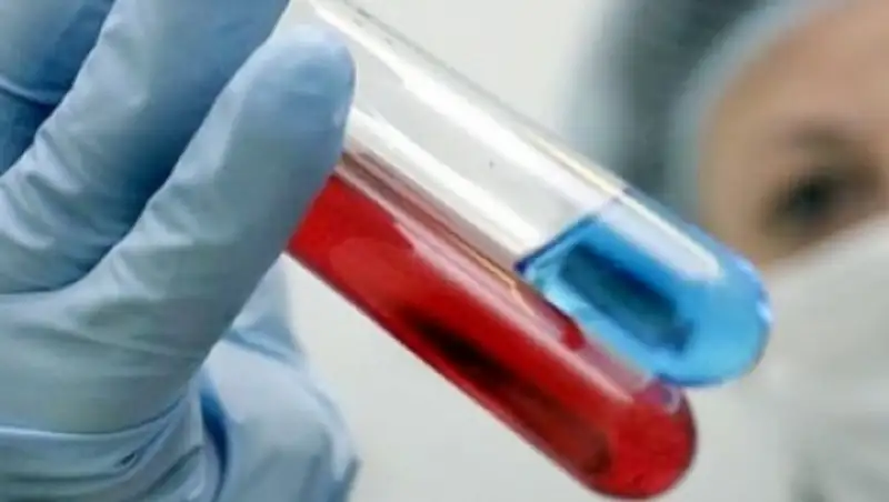 В Казахстане не решен вопрос лечения иностранцев с ВИЧ — Д.Карымсакова