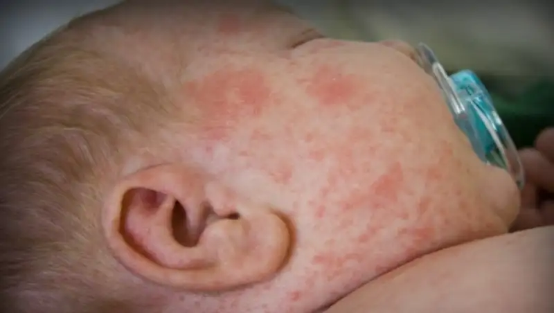 Уровень заболеваемости краснухой в Казахстане сократился в 150 раз