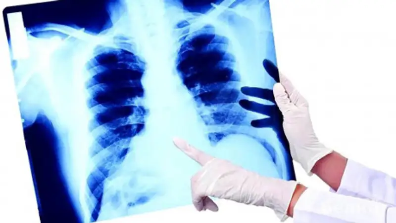 В Казахстане за сутки выявили 531 больного с коронавирусной пневмонией - 7 умерли