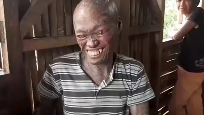 "Человека-змею" с Филиппин всю жизнь принимают за дьявола