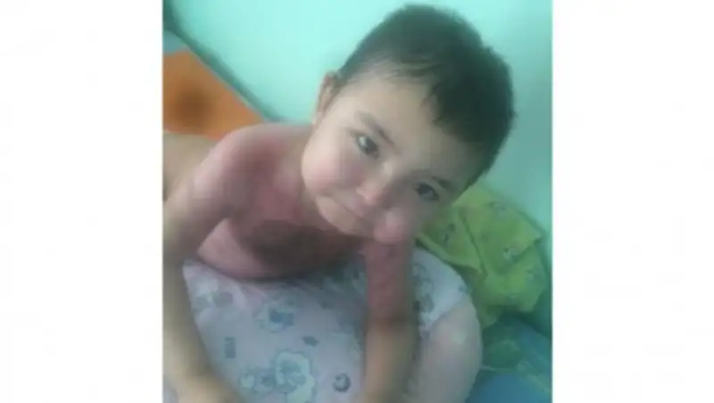 В Кокшетау мальчика, который опрокинул на себя кастрюлю с бульоном, готовят к выписке