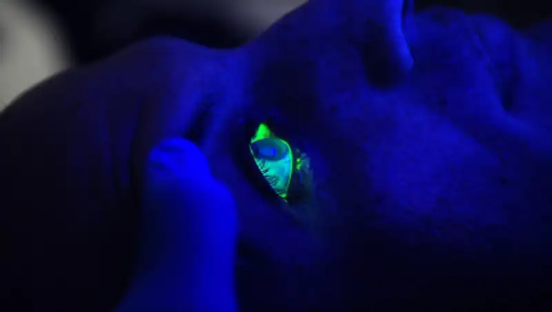 Диагностика и лечение онкологии глаза