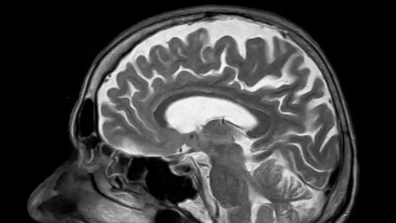 Больные раком мозга назвали неочевидные симптомы заболевания