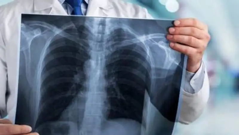 25 человек скончались от КВИ и пневмонии за сутки в Казахстане