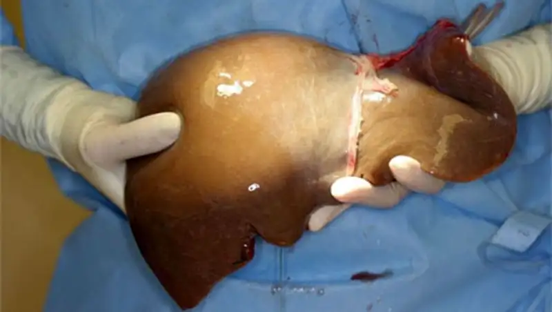 Более тысячи казахстанцев нуждаются в донорской печени