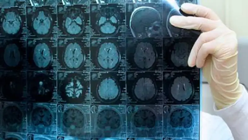 В Канаде зафиксировали вспышку загадочной смертельной болезни