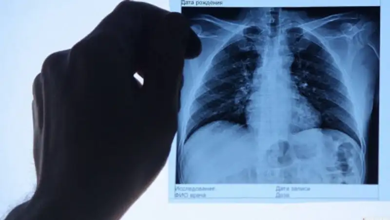 Озвучена статистика по пневмонии за сутки в Казахстане