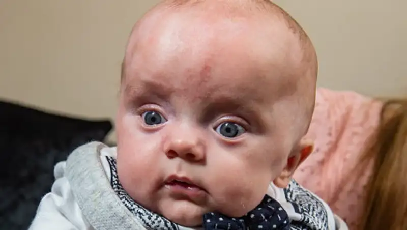 "Был красный, как кусок мяса". Ребенок без кожи родился в Великобритании