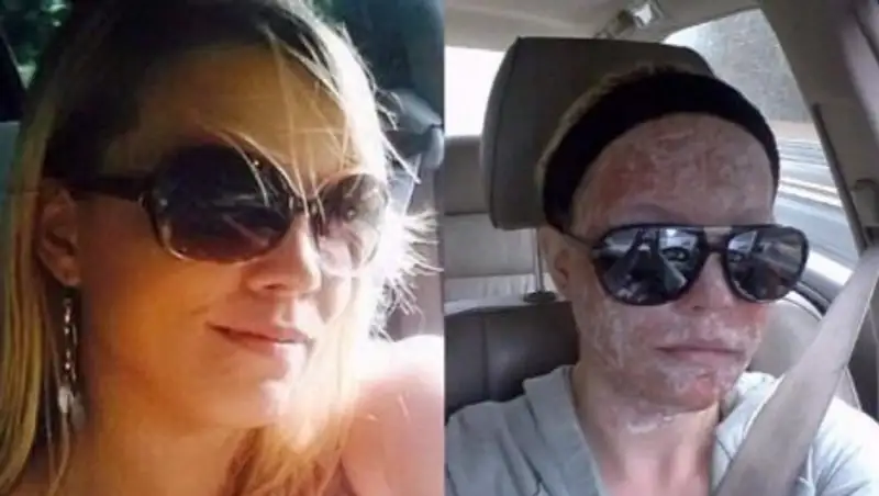 Модель 6 лет не могла выходить из дома, стесняясь своей внешности после аварии