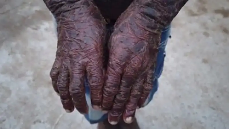 Мальчика с "чешуей" по всему телу прозвали змеей