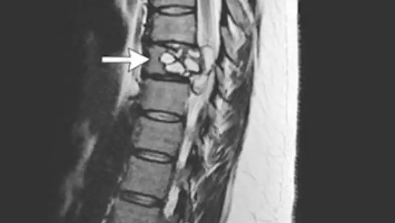 Собачий паразит проник в позвоночник француженки и испортил ей жизнь