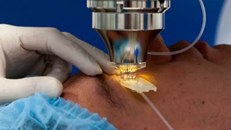 В каких случаях нельзя делать лазерную коррекцию зрения