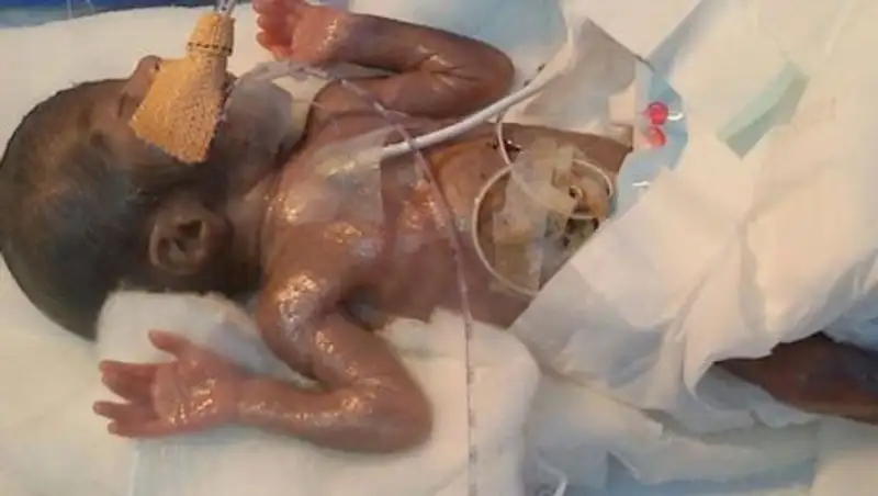 В Индии прошла первая в мире операция на сердце у 500-граммового младенца