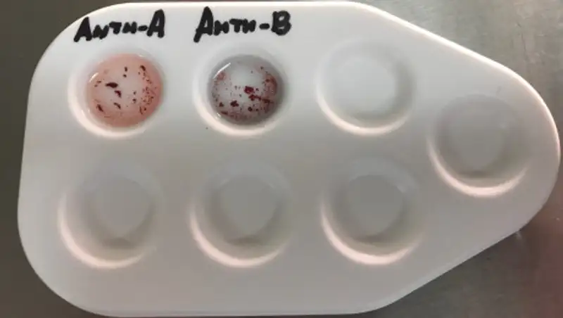 Ученые рассматривают влияние COVID-19 на группу крови
