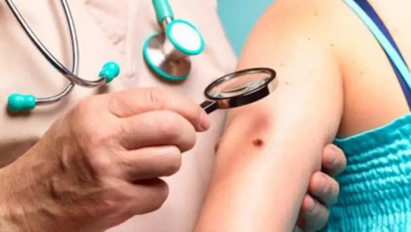 В Казахстане растет заболеваемость меланомой