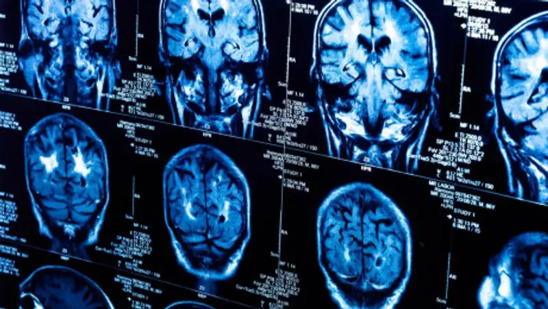 Алматинские врачи прооперировали женщину, которой 5 лет не могли поставить диагноз