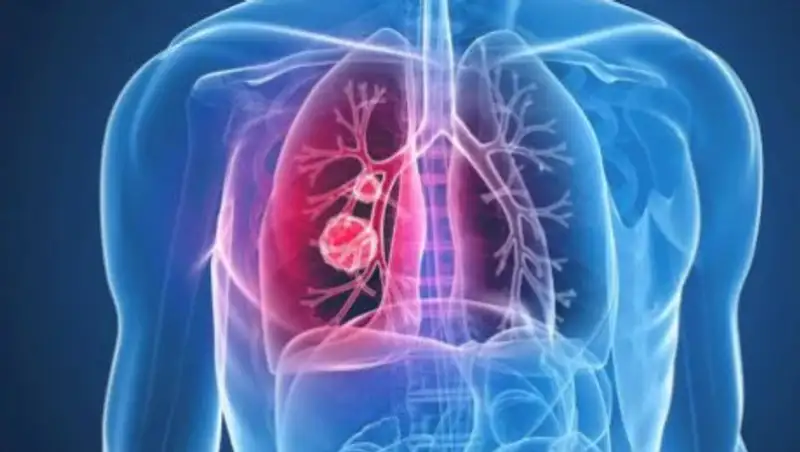 Как не заболеть пневмонией