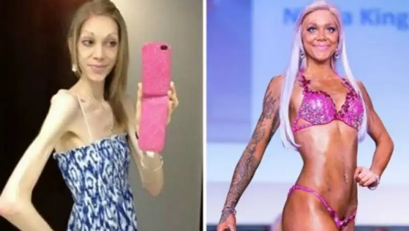 Страдавшая анорексией британка победила на конкурсе по бодибилдингу