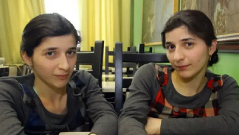 Власти РФ решили дать гражданство разделенным сиамским близнецам Зите и Гите 