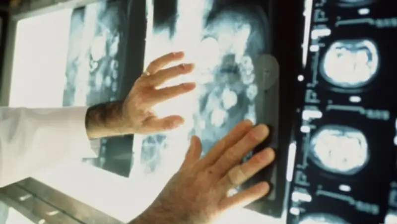 В Казахстане снизился показатель смертности от онкозаболеваний