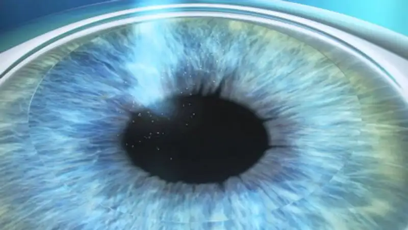 Как скорректировать зрение при помощи ФКР