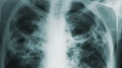 В Польше очередная вспышка "болезни легионеров": уже умерли одиннадцать человек, фото - Новости Zakon.kz от 29.08.2023 03:20