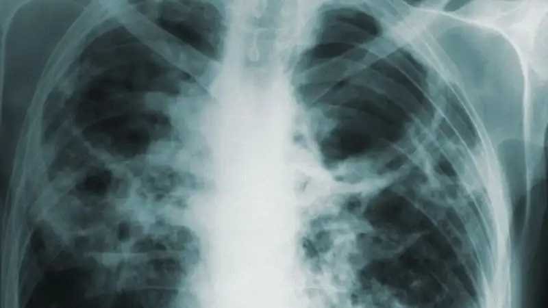 В Польше очередная вспышка "болезни легионеров": уже умерли 11 человек