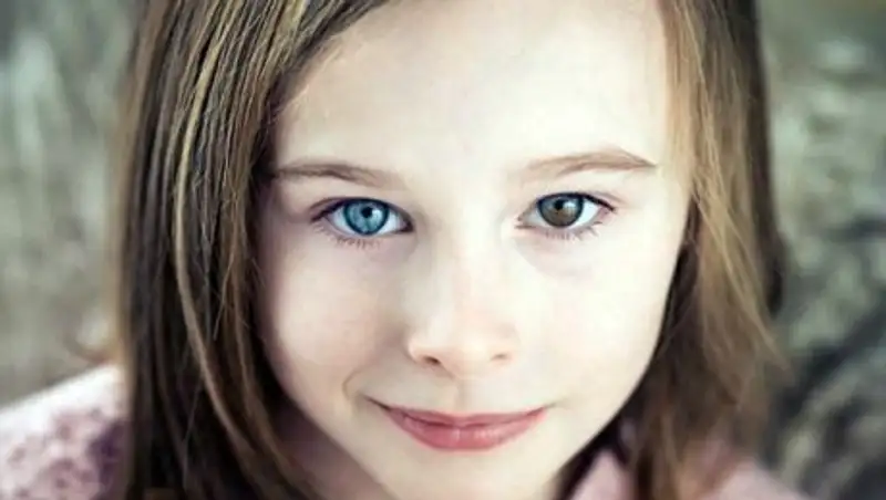 Один белый, другой серый. В чем причина разного цвета глаз