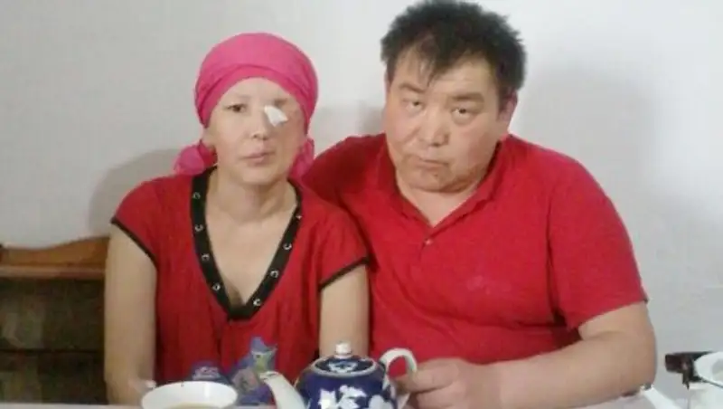 Алматы облысы тұрғынының тісжегіден басталған дерті асқынып қатерлі ісікке айналған 