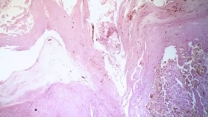 Успешно испытана вакцина против рака