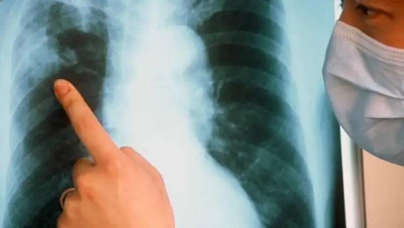 Специалисты: Распространение туберкулеза у студентов - вина руководства вузов