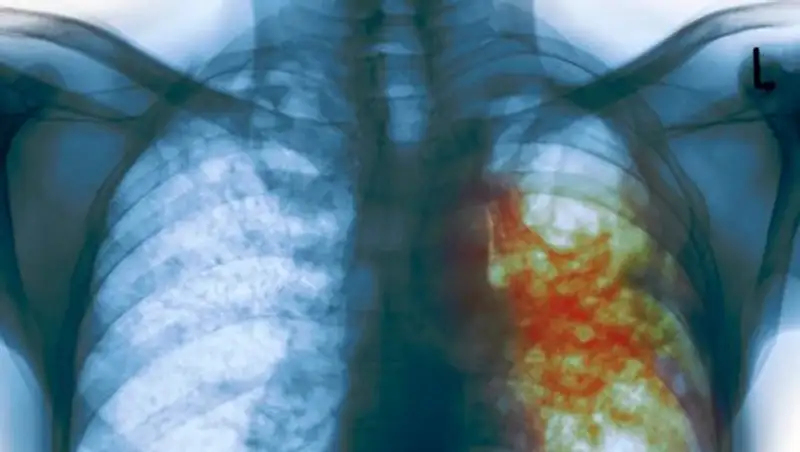 Биртанов: Лечить тяжелую форму туберкулеза в РК будут новым препаратом