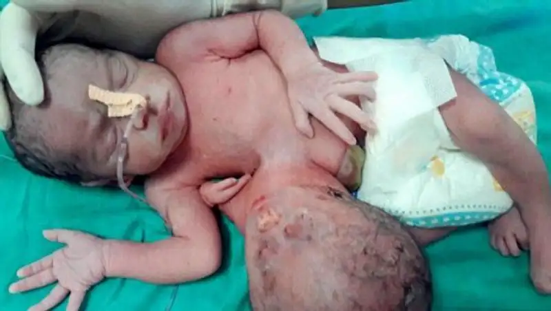 В Индии родилась девочка со второй головой в области живота