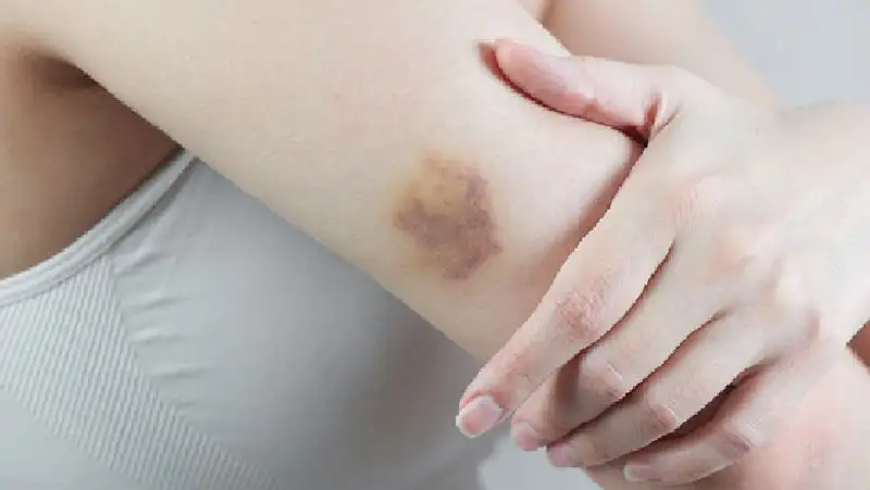 Врачи рассказали, кому нужно обратить внимание на синяки на теле