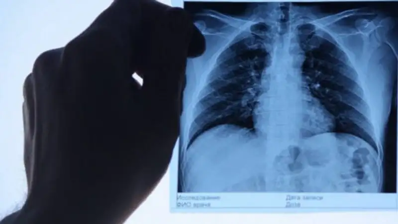 Переболевшие теряют треть легкого: Кисикова объяснила возможные осложнения от COVID-19