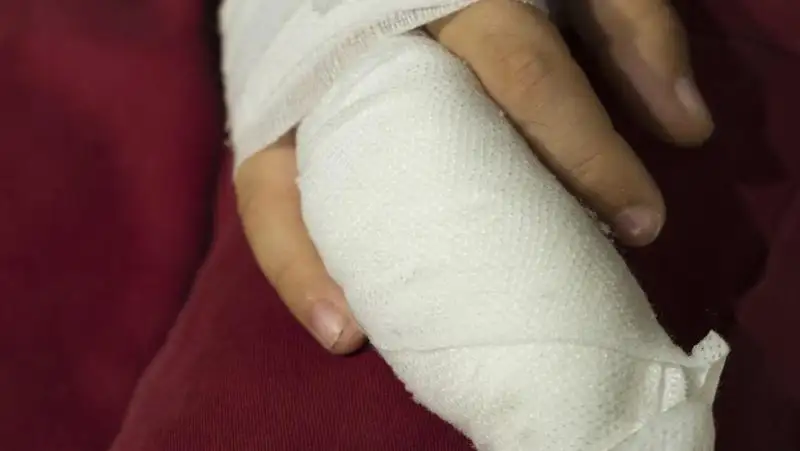 Еще одному подростку отрезало палец в Уральске