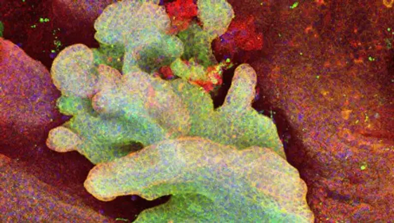 Ученые впервые увидели, как "рождается" рак кожи