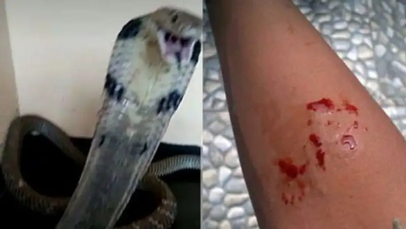 Укушенный коброй школьник искал помощи в соцсетях