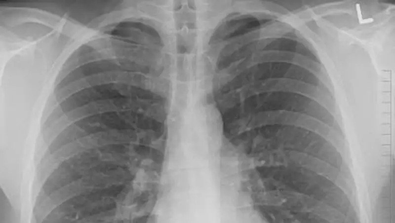 Число больных пневмонией и ОРВИ уменьшилось в Казахстане