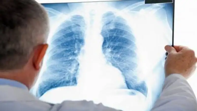 В Казахстане от коронавируса и пневмонии скончались 6 человек