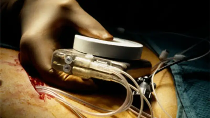 ВОЗ предложили заново использовать сердечные имплантаты, фото - Новости Zakon.kz от 19.11.2013 19:40