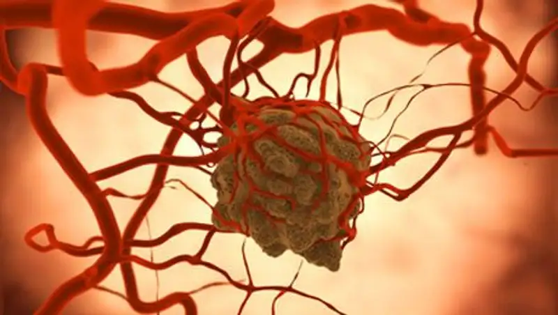 В Казахстане откроют первую школу для больных системной красной волчанкой