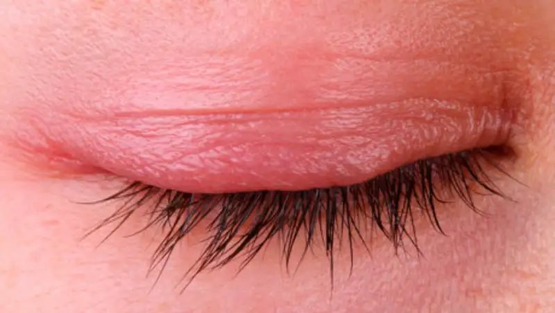 Каковы причины покраснения век