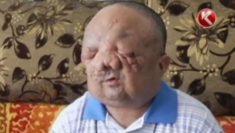 Врачи из Испании совершенно бесплатно удалили огромную опухоль на лице жителю Семея