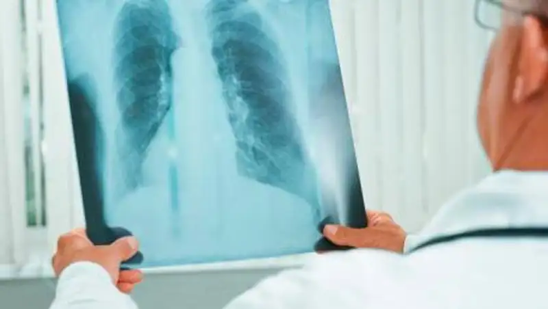 Три казахстанца скончались от пневмонии за сутки