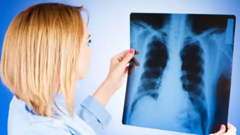 Туберкулезбен ауыратын 20-дан астам жамбылдық мәжбүрлі ем қабылдауға жіберілді 