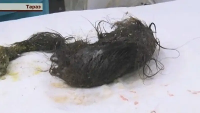 Хирурги Тараза в шоке: в желудке ребенка оказалось больше килограмма волос