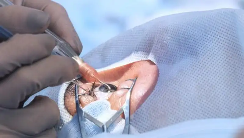 Непроникающая глубокая склерэктомия. Метод лечения глаукомы