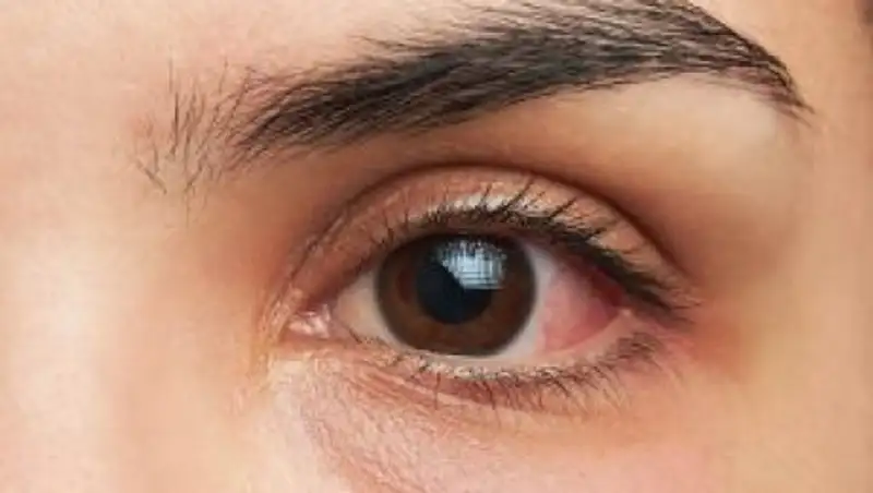 Заболевания роговицы. Что необходимо знать